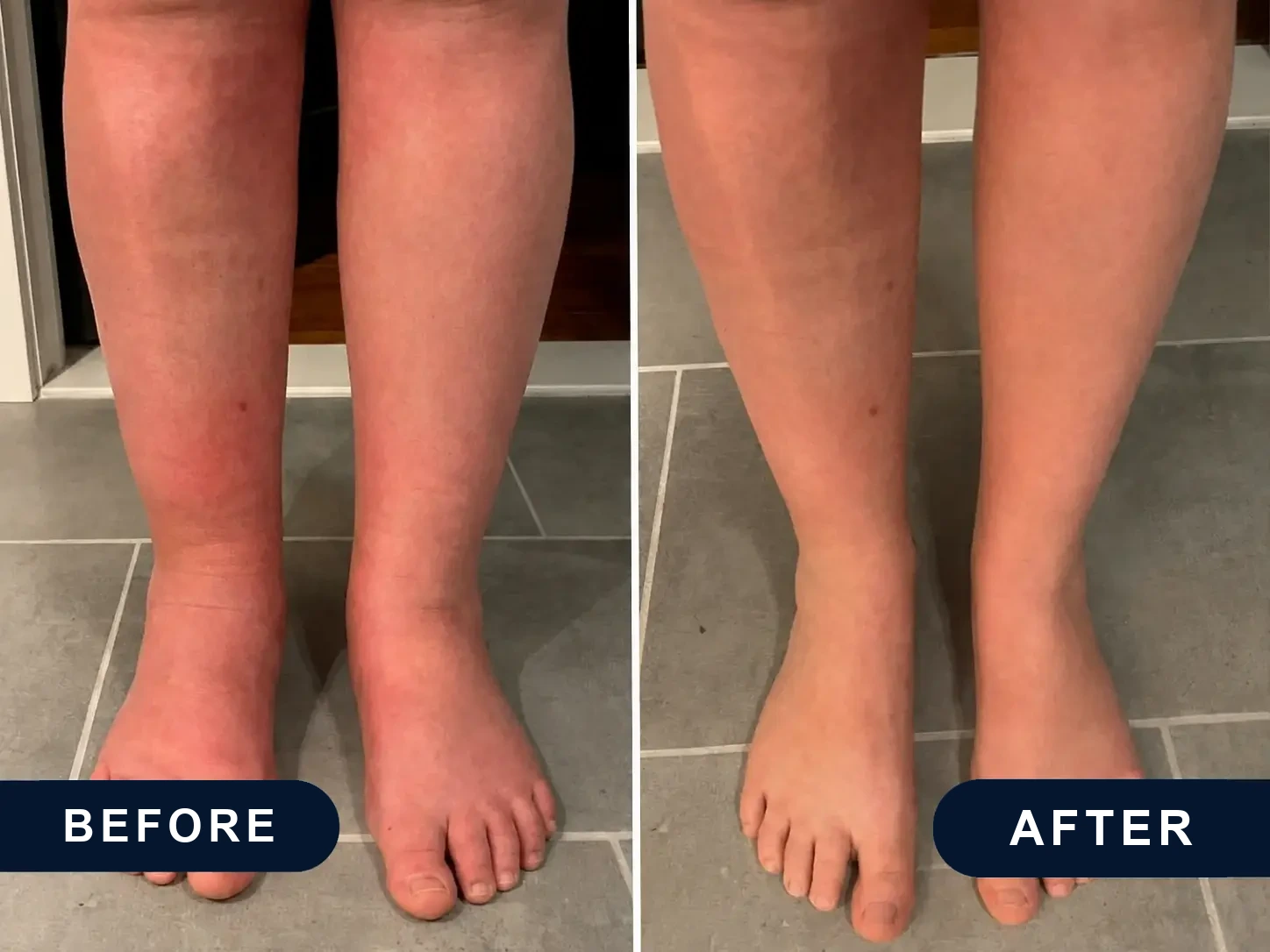 Before and after: red, swollen shins and feet, then the same legs after