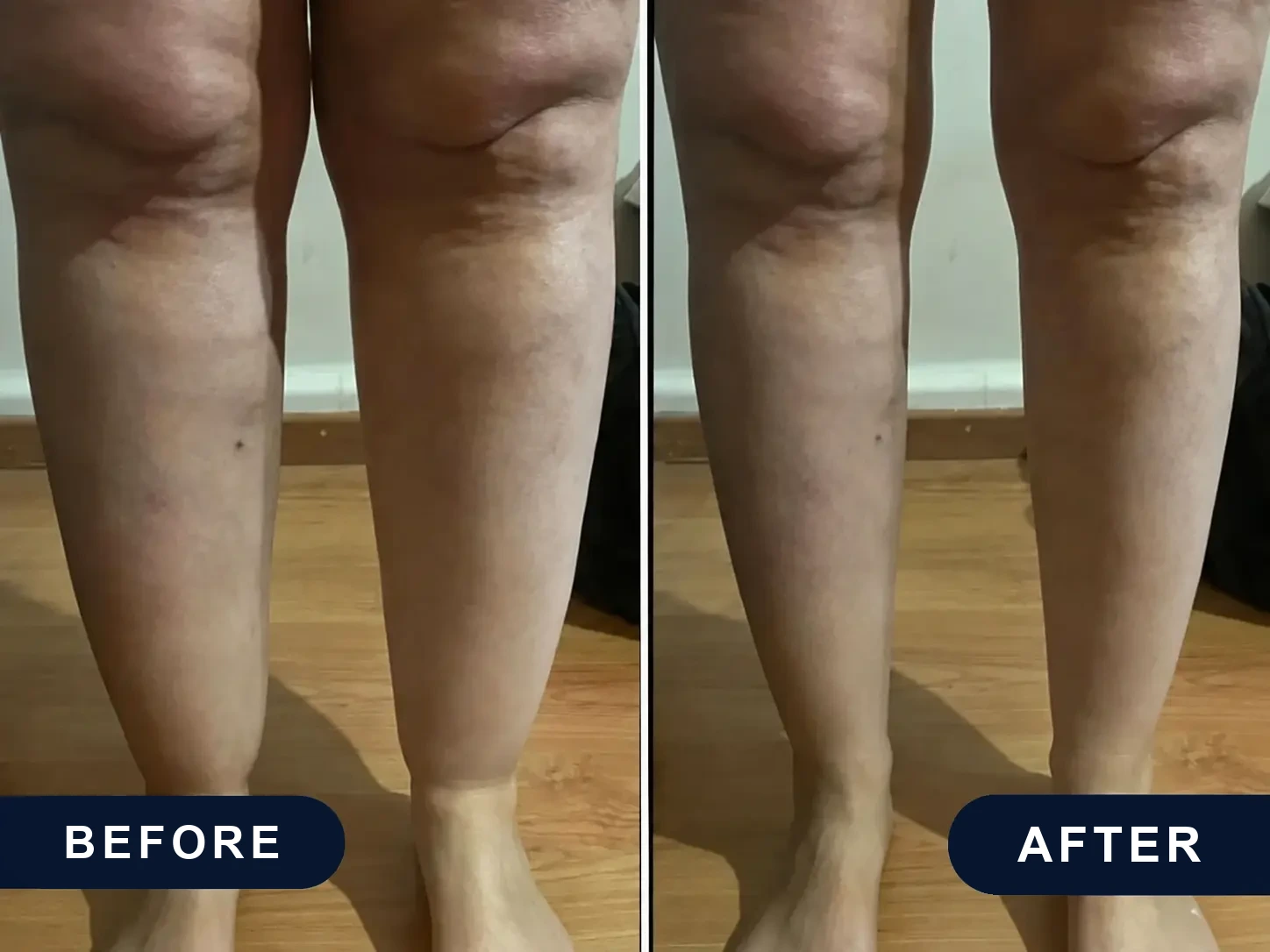 Before and after: swollen lower legs and knees, then the same legs after