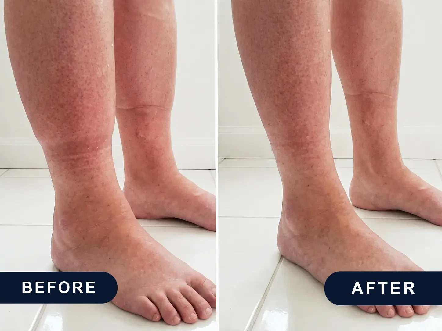 Before and after: swollen, blotchy ankle and foot, then the same ankle after
